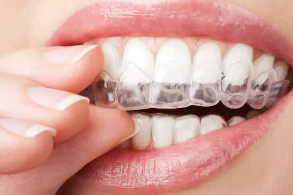 Braces