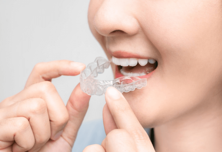invisible braces